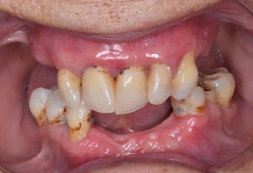 Corona sobre implante zirconio tras colocación en clínica dental Málaga